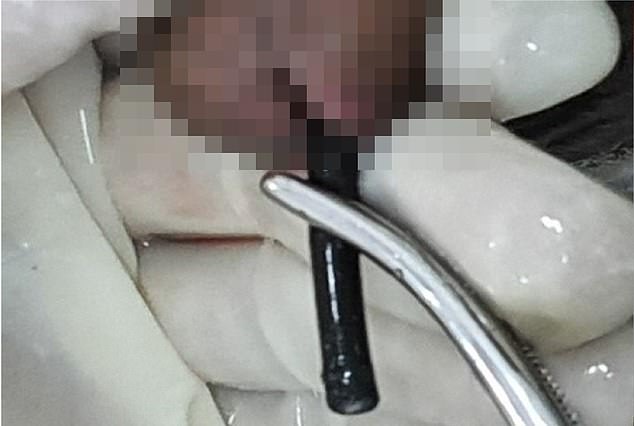 Den Ärzten gelang es, die Spitze des Drahts mit einer Pinzette zu greifen und den Draht wieder aus seinem Penis herauszuziehen