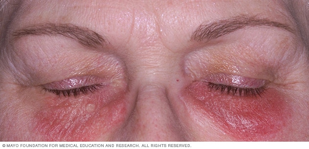Kontaktdermatitis unter den Augen kann durch Kosmetika verursacht werden