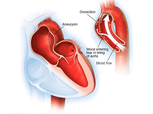 Aortenaneurysma und Aortendissektion