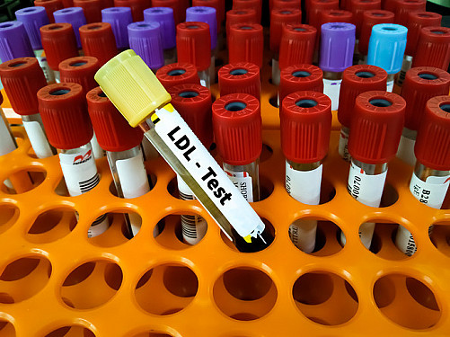 Versuchen Sie, hartnäckig hohes LDL-Cholesterin zu senken?