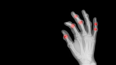 Behandlungen für rheumatoide Arthritis können das Demenzrisiko senken