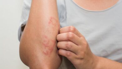 3 Tipps zum Entfernen trockener Haut aufgrund von Ekzemen