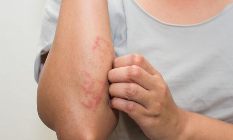 3 Tipps zum Entfernen trockener Haut aufgrund von Ekzemen
