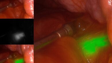 A more accurate lung nodule biopsy: Combining shape-sensing bronchoscopy with mobile 3D imaging