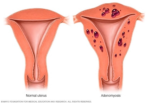 Normaler Uterus vs. Uterus mit Adenomyose
