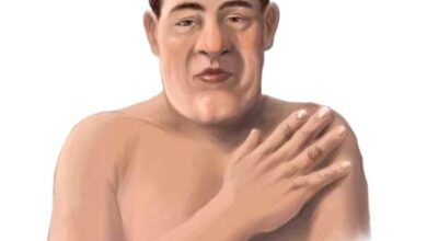 Person mit Akromegalie