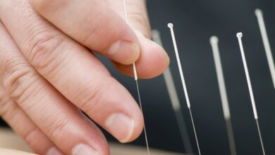 Akupunktur verbessert signifikant Schmerzen im unteren Rücken oder Becken während der Schwangerschaft