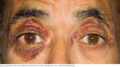 Purpura um die Augen, ein Zeichen von Amyloidose