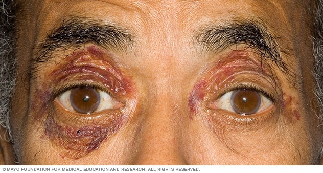 Purpura um die Augen, ein Zeichen von Amyloidose