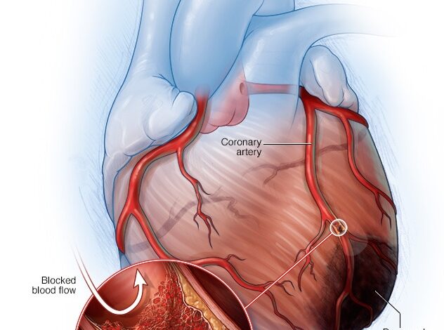 Blockierte Arterie und verletztes Gewebe bei einem Herzinfarkt