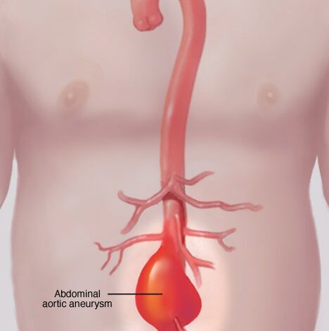 Bauchaortenaneurysma