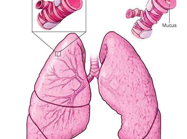 Illustration dessen, was während eines Asthmaanfalls passiert