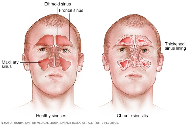 Chronische Sinusitis