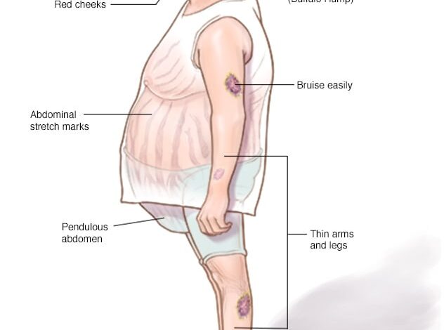 Cushing-Syndrom