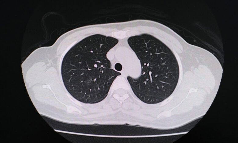 Study: Chest CT Findings in Marijuana Smokers. Image Credit: PIJITRA PHOMKHAM / Shutterstock.com