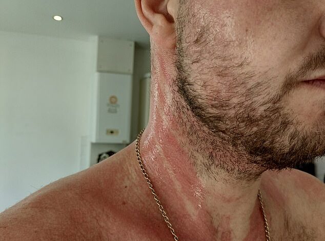 Der 34-jährige Friseur, der unter einer allergischen Reaktion auf Johnsons Babyshampoo litt, sagt, es habe sich wie eine „Säureverbrennung“ im Nacken angefühlt