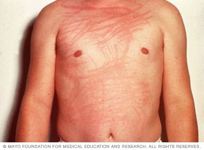 Foto von Dermatographie