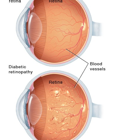 Schwere nichtproliferative diabetische Retinopathie