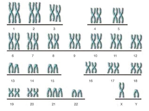 Illustration, die die Chromosomen einer Person mit Down-Syndrom zeigt