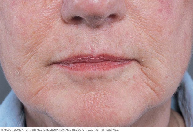 Falten im Gesicht