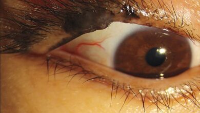 Als die 47-jährige Frau zu einem Arzt ging, fanden sie etwas, das unter ihren Augenlidern hervorragte, was den Ärzten den ersten Hinweis gab, dass etwas direkt über ihrem rechten Auge nicht stimmte.