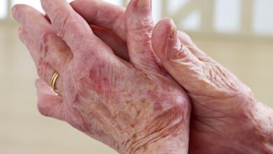 Ganzkörper-PET/CT-Scans können eine systemische Gelenkbeteiligung bei Patienten mit Arthritis effektiv darstellen