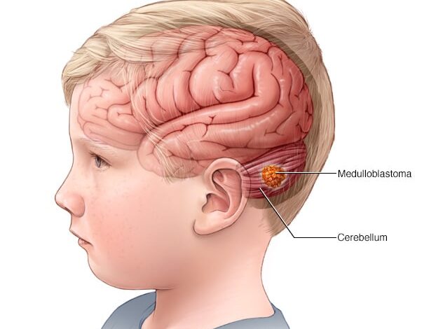 Kind mit einem Medulloblastom-Gehirntumor