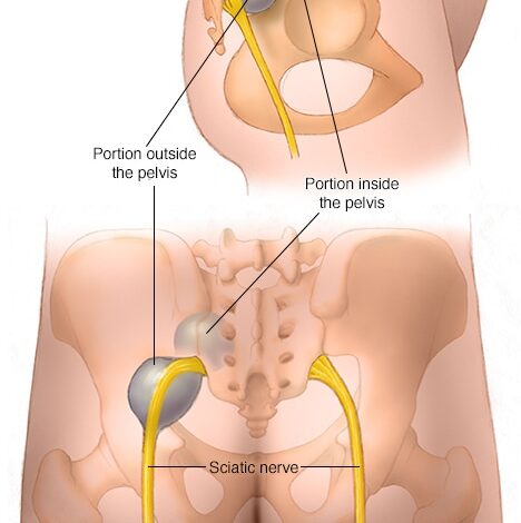 Hanteltumor