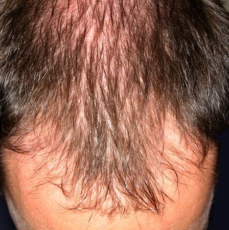 Bei Männern beginnen die Haare oft, sich von der Stirn zurückzuziehen.