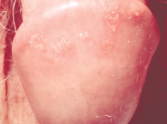 Foto von genitalen Herpesbläschen auf einem Penis