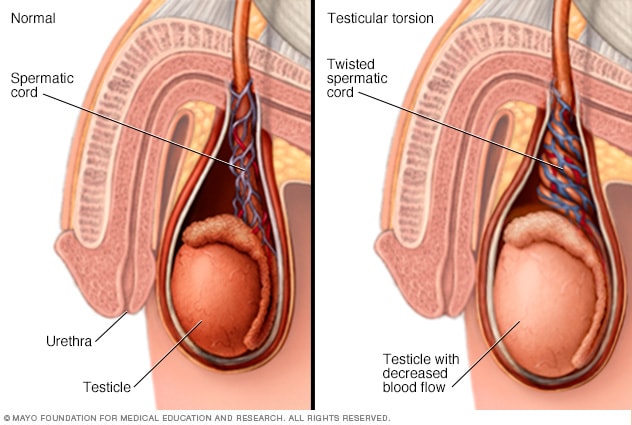 Illustration des Penis vor und während der Hodentorsion