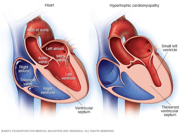 Typisches Herz und Herz mit hypertropher Kardiomyopathie