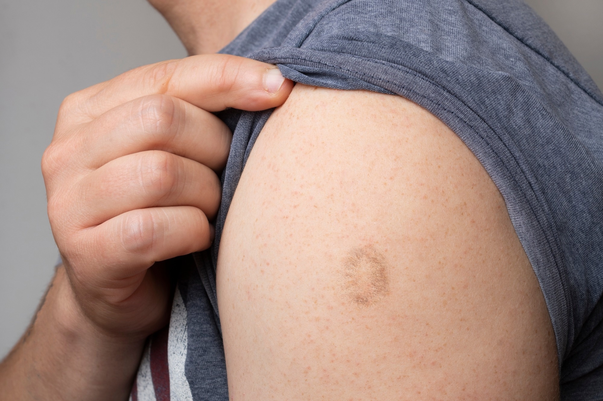 Rückblick: Monkeypox Goes North: Laufende weltweite Monkeypox-Infektionen beim Menschen. Bildnachweis: Cristian Storto / Shutterstock