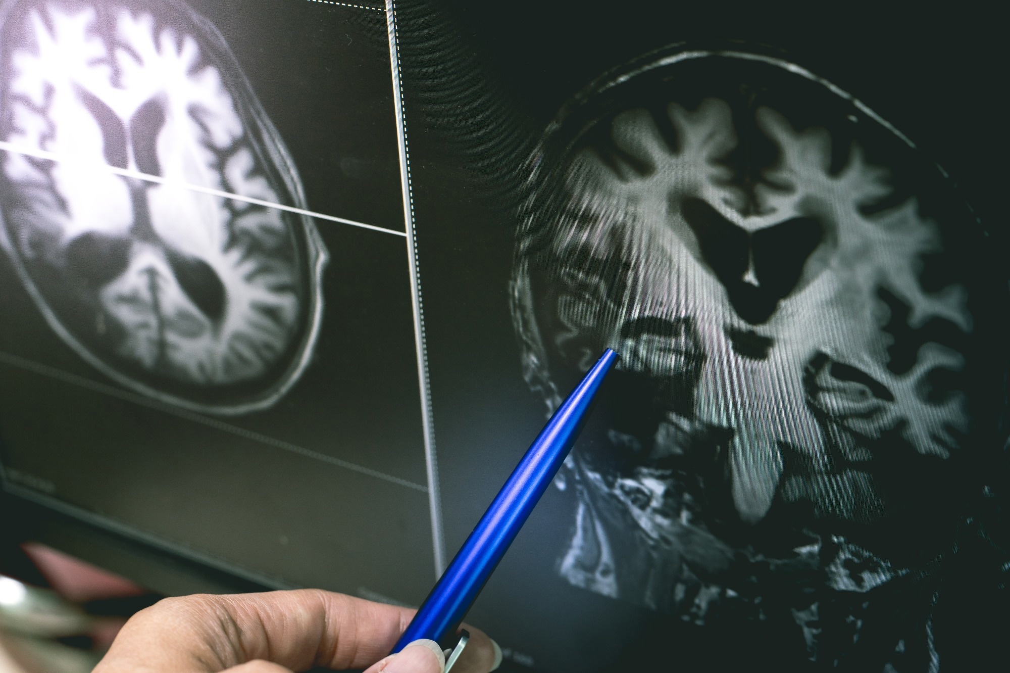 Studie: Zusammenhang zwischen der Anwendung von systemischen und inhalativen Glukokortikoiden und Veränderungen des Gehirnvolumens und der Mikrostruktur der weißen Substanz: eine Querschnittsstudie unter Verwendung von Daten der UK Biobank. Bildnachweis: Atthapon Raksthaput / Shutterstock