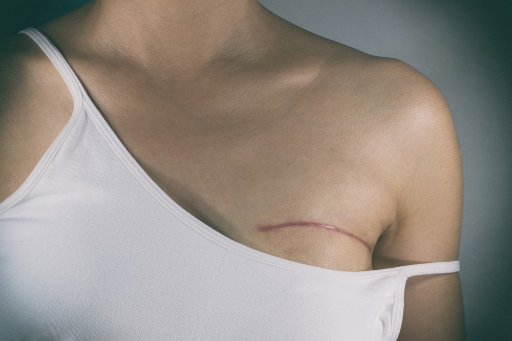 Studie: Vermeidung einer Brustoperation bei invasivem Brustkrebs bei Patientinnen mit außergewöhnlichem Ansprechen auf eine neoadjuvante systemische Therapie: eine multizentrische, einarmige Phase-2-Studie. Bildnachweis: Pradit.Ph / Shutterstock.com