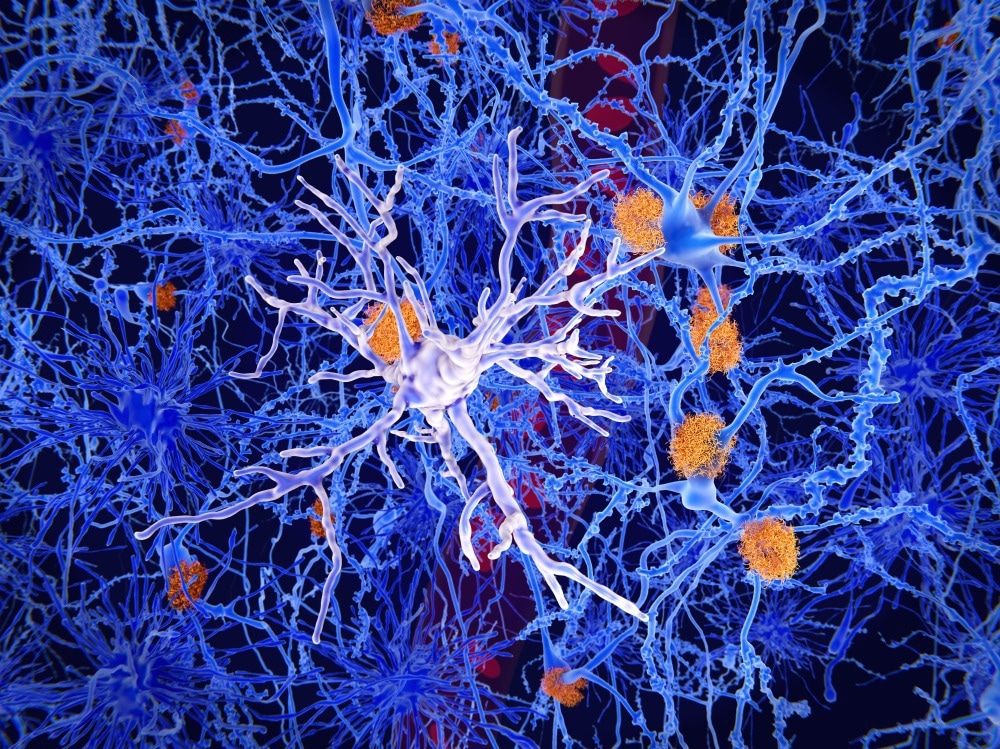 Studie: Neue Rollen der angeborenen und adaptiven Immunität bei der Alzheimer-Krankheit. Bildnachweis: Juan Gaertner/Shutterstock Studie: Neue Rollen der angeborenen und adaptiven Immunität bei der Alzheimer-Krankheit. Bildnachweis: Juan Gaertner/Shutterstock
