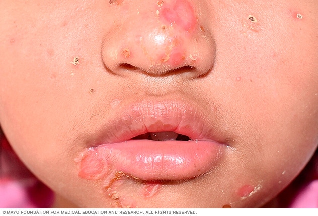 Impetigo Wunden