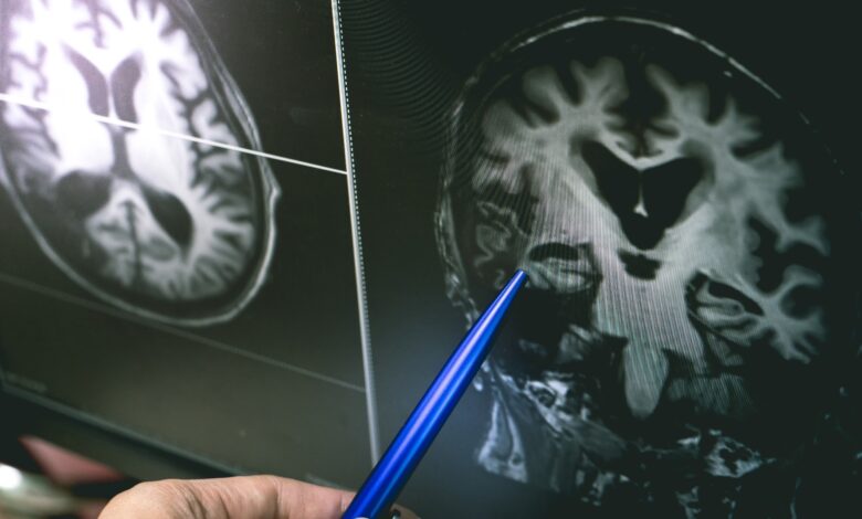 Study: Association between use of systemic and inhaled glucocorticoids and changes in brain volume and white matter microstructure: a cross-sectional study using data from the UK Biobank. Image Credit: Atthapon Raksthaput / Shutterstock