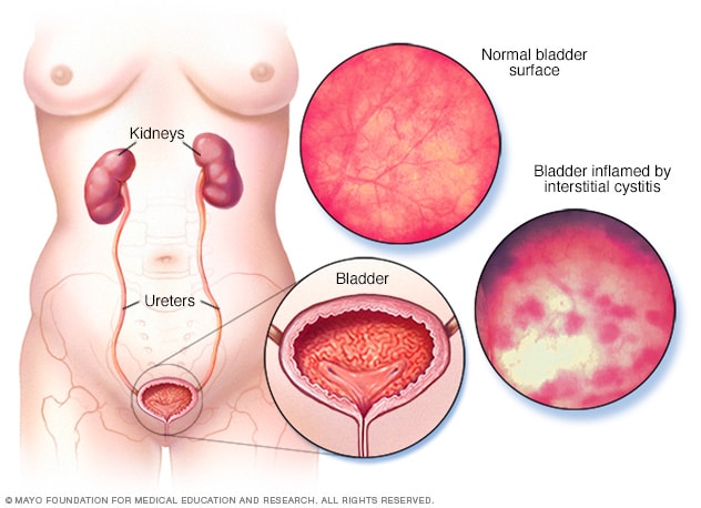 Illustration, die die Wirkung einer interstitiellen Zystitis auf die Blase zeigt