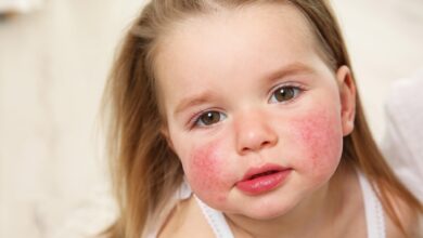 Study: Early-life exposure to air pollution associated with food allergy in children: Implications for ‘one allergy’ concept.  Image Credit: Africa Studio / Shutterstock