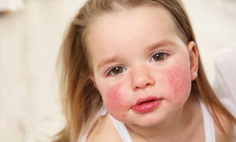 Study: Early-life exposure to air pollution associated with food allergy in children: Implications for ‘one allergy’ concept. Image Credit: Africa Studio / Shutterstock