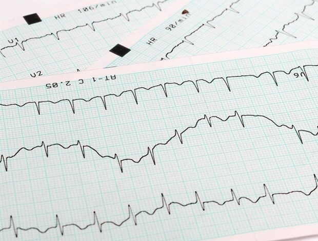 Klinische Merkmale und Ergebnisse einer fulminanten Myokarditis, die durch eine landesweite Kohortenstudie aufgedeckt wurden