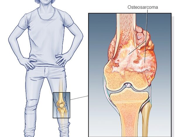 Osteosarkom