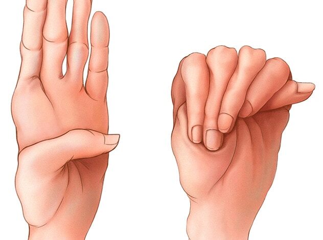 Abnormal lange Finger, die beim Marfan-Syndrom häufig vorkommen