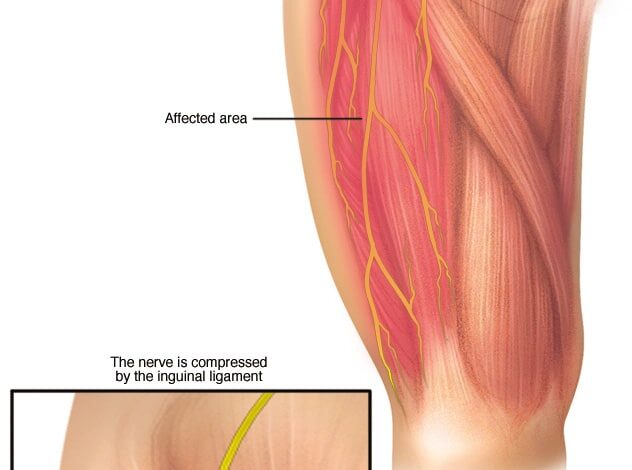 Meralgia paresthetica