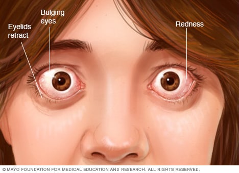 Augenkomplikationen im Zusammenhang mit Morbus Basedow
