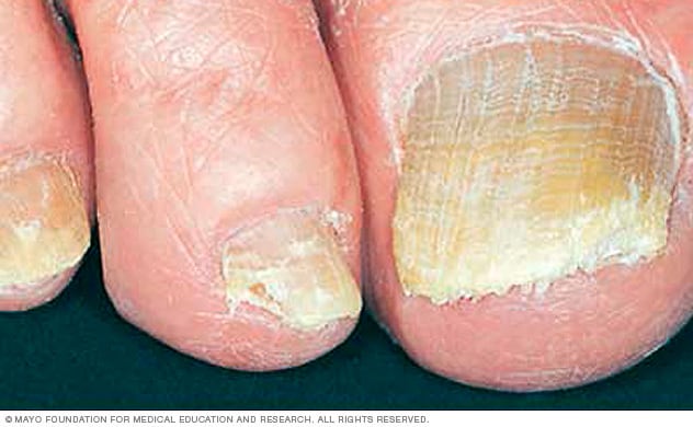 Nagelpilz