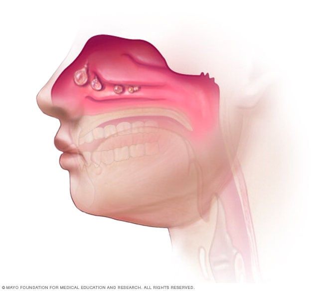 Nasenpolypen in Nase und Nebenhöhlen