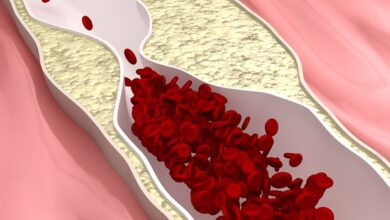 Neuer Ansatz liefert besseres Verständnis von Atherosklerose in den Beinarterien