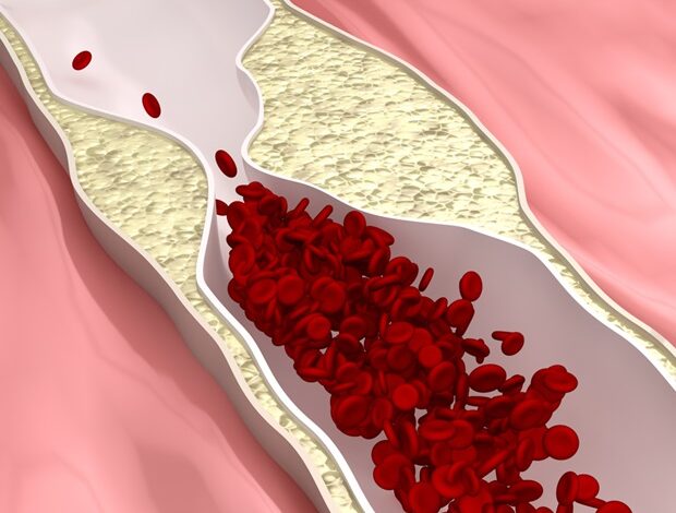 Neuer Ansatz liefert besseres Verständnis von Atherosklerose in den Beinarterien